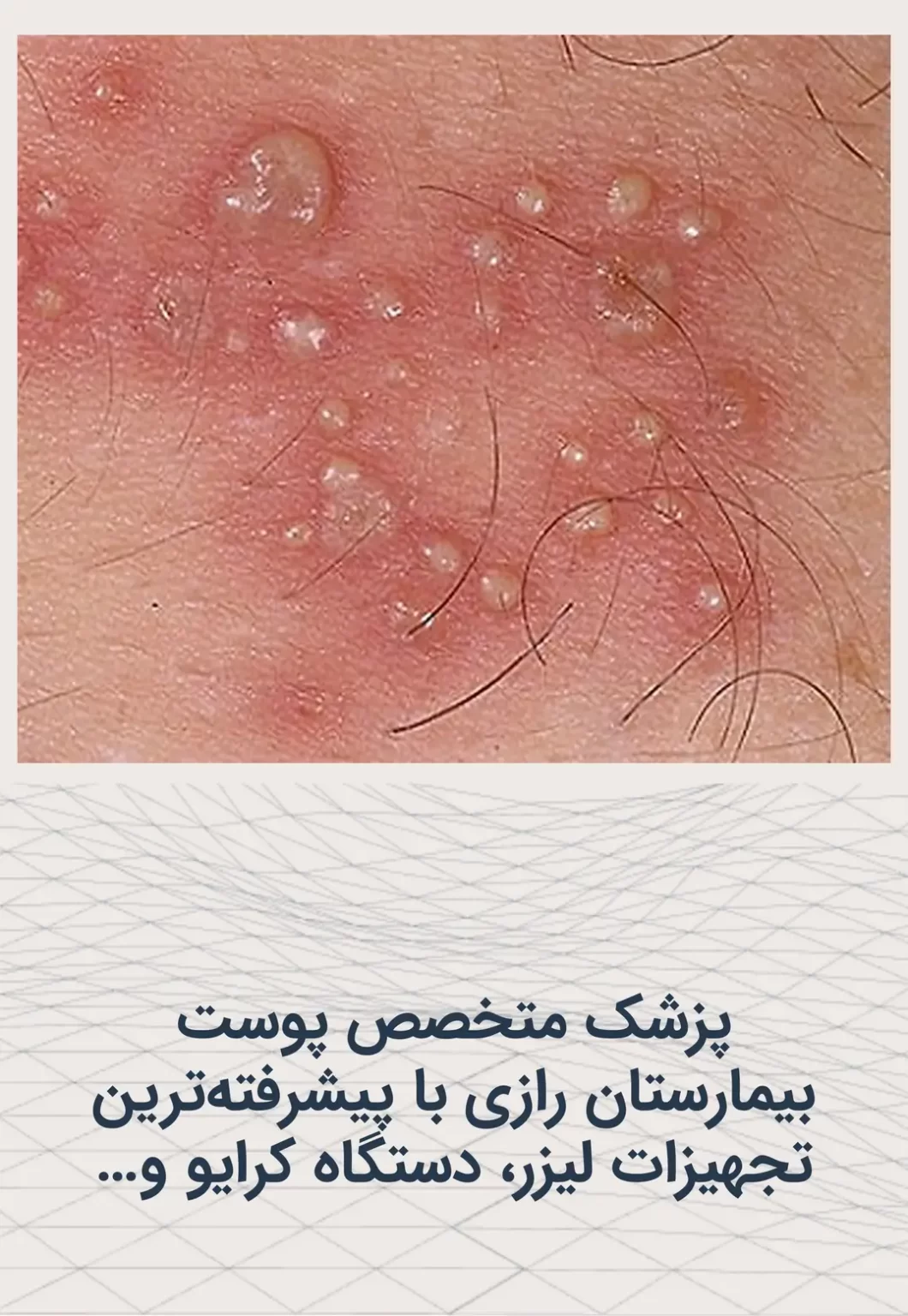 تصویر زگیل تناسلی