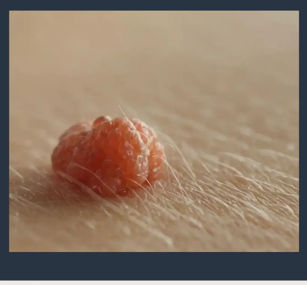 درمان قطعی HPV